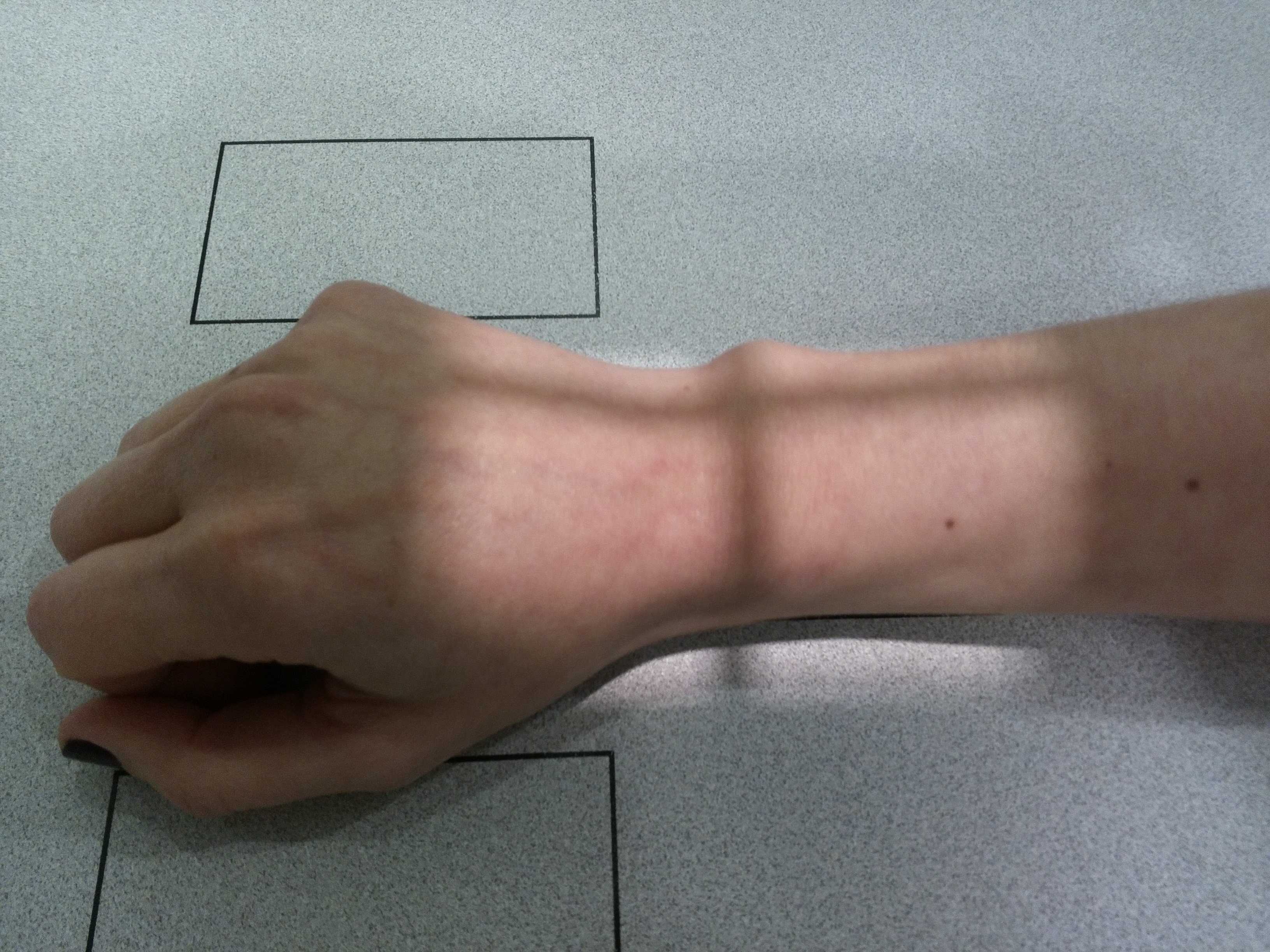 Radiografía PA Muñeca